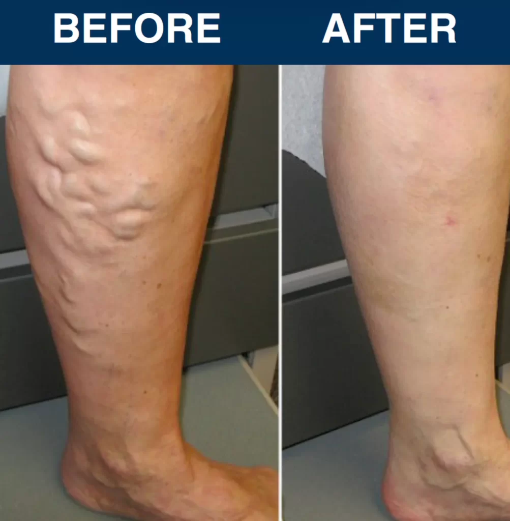 Viva Vein patient testimonial