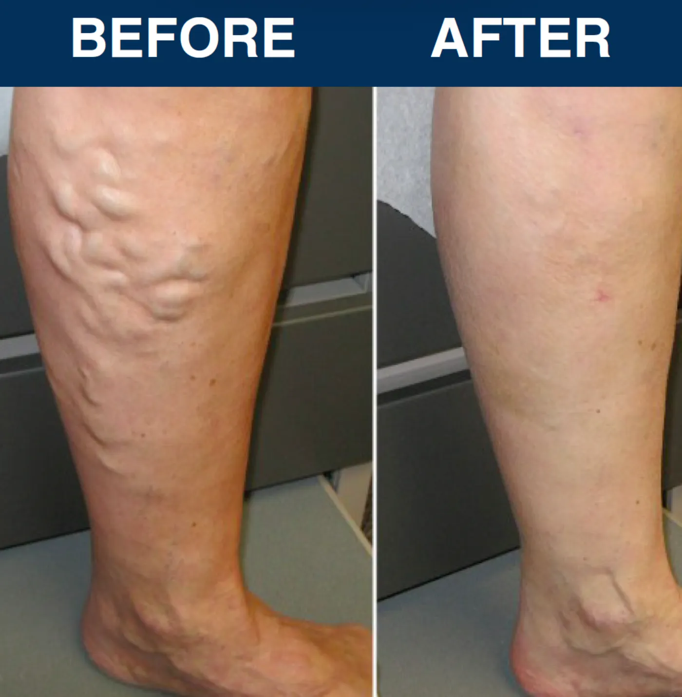 Viva Vein patient testimonial